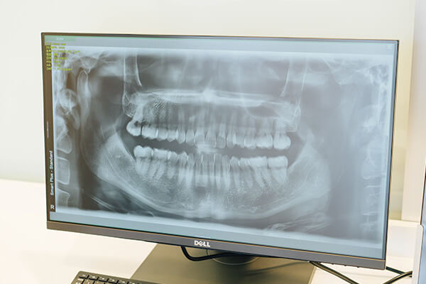 デジタルX線写真：歯根膜空隙と歯槽硬線までみえるキレイな写真