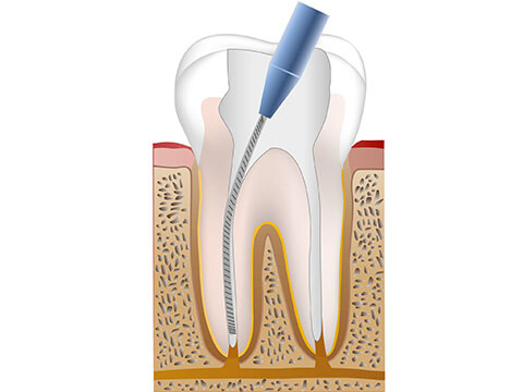 根の中の感染した神経および汚染歯質の除去