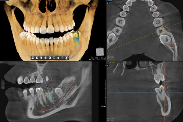 歯科用CTを用いた診査診断