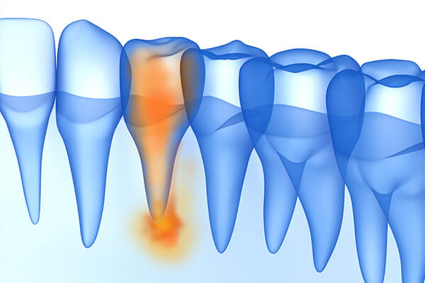 歯を残す歯根端切除術