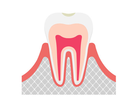 C0：歯の表面の虫歯