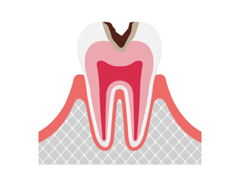 C2：象牙質の虫歯