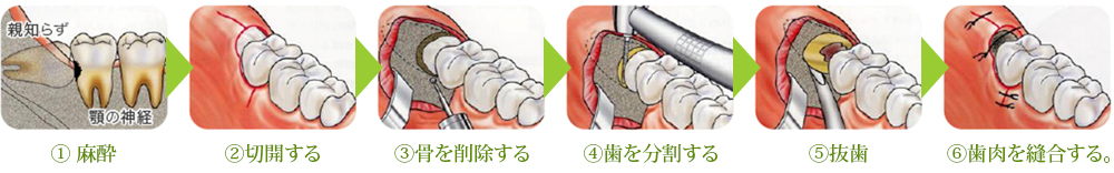 親知らず抜歯の術式（手順）