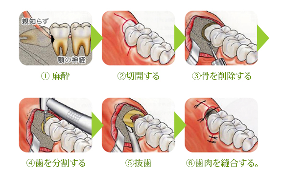 親知らず抜歯の術式（手順）