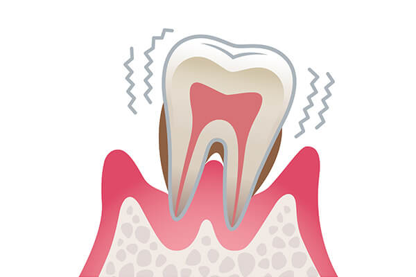 歯周病には歯肉炎・歯周炎の二つがあります