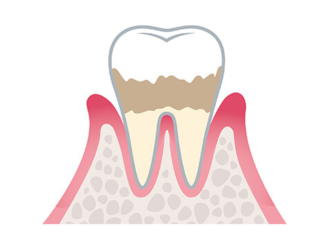 軽度歯周炎