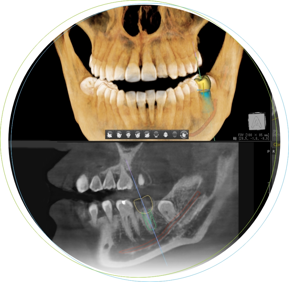 歯科用CT・拡大鏡 を使用