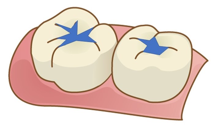 ①咬む面　②歯と歯の間　③歯と歯茎の境目