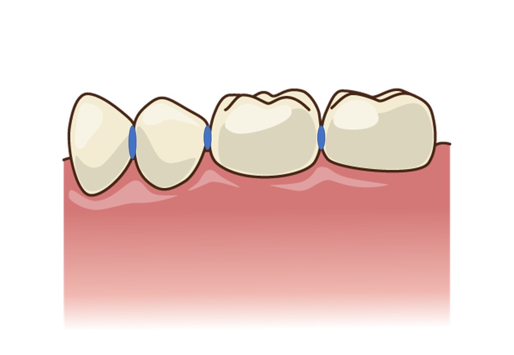 ①咬む面　②歯と歯の間　③歯と歯茎の境目