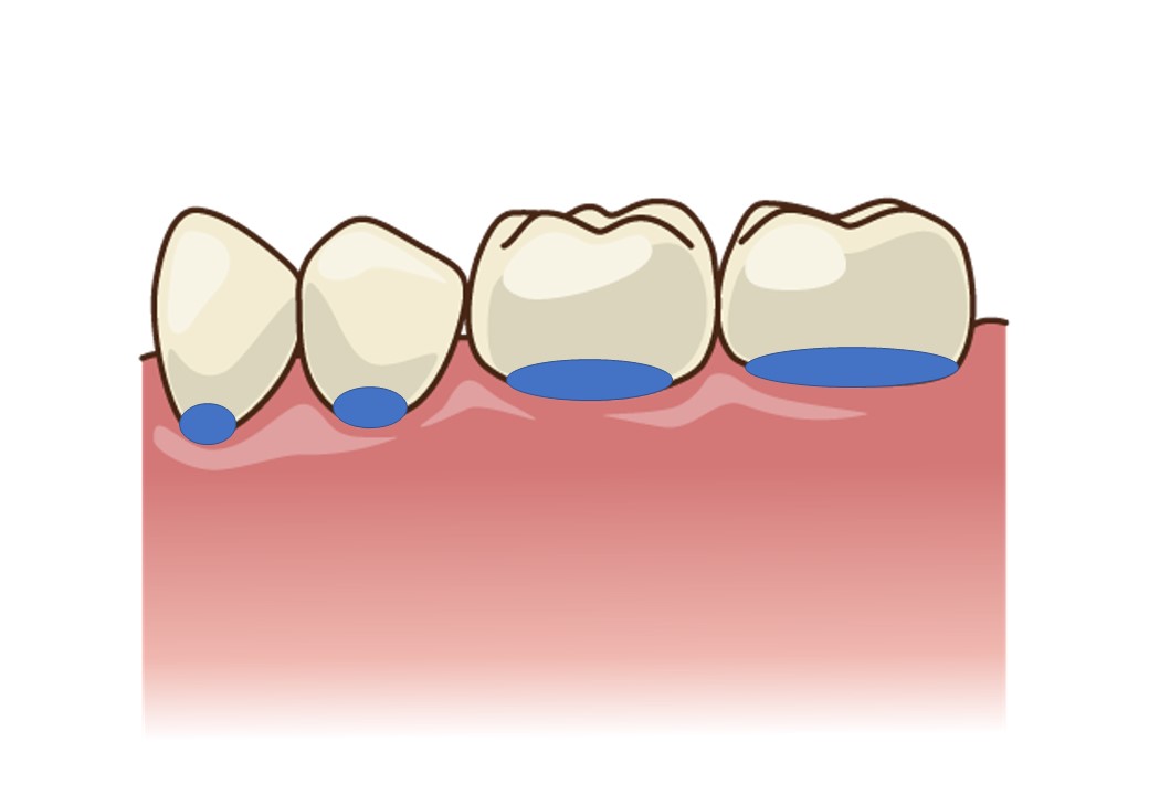 ①咬む面　②歯と歯の間　③歯と歯茎の境目